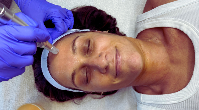 microneedling
