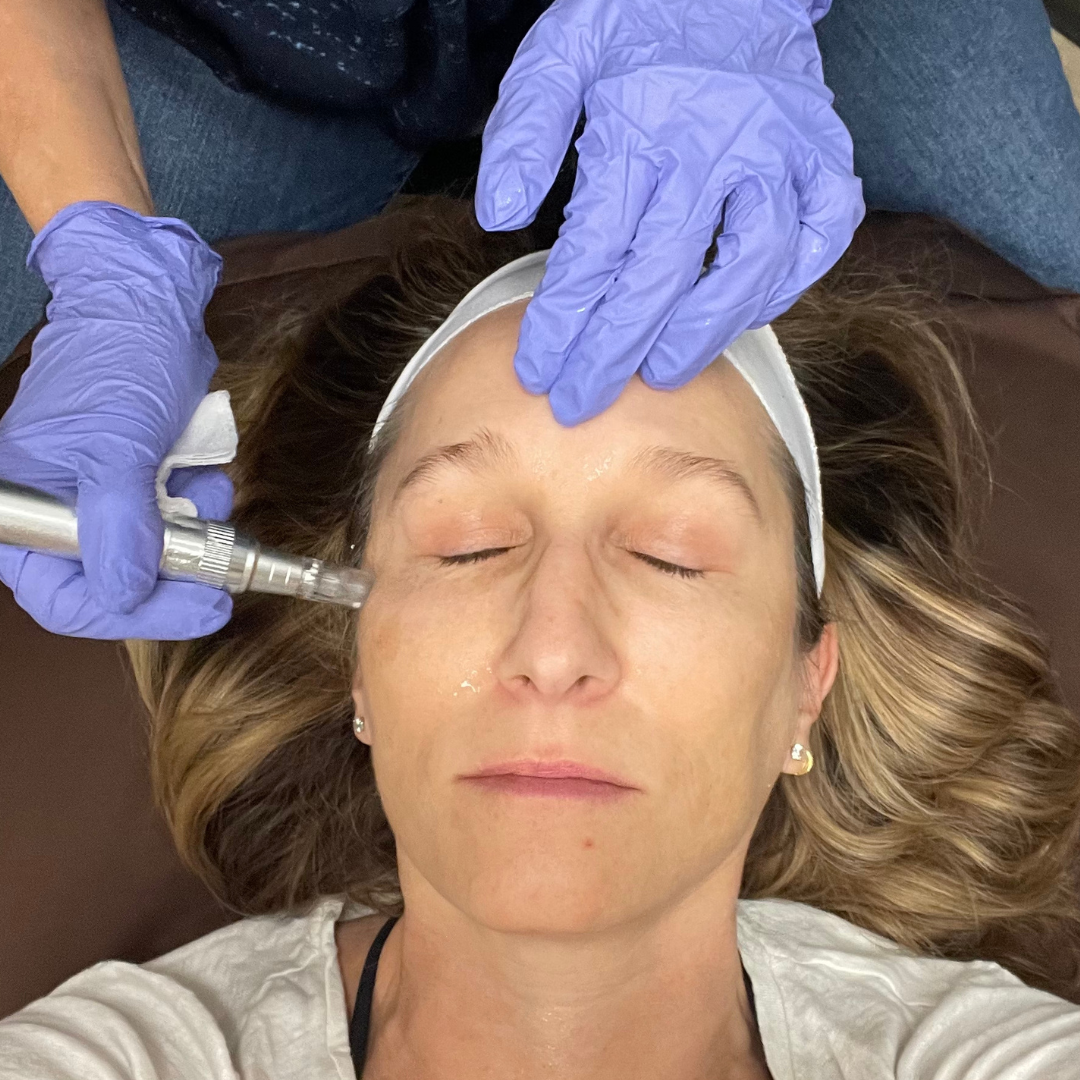 Holistic Micro+ Needling (in-person)